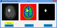 طبقه بندی تومور مغزی با شبکه عصبی SOM با متلب